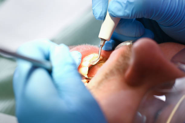 Best Dental Abscess Treatment in Cabana Colony, FL